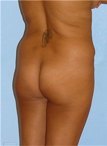 Buttock Lift with Augmentation Before Photo by Siamak Agha, MD PhD FACS; Newport Beach, CA - Case 43813