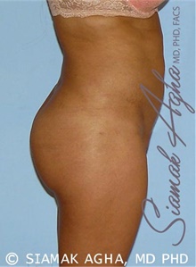 Buttock Lift with Augmentation After Photo by Siamak Agha, MD PhD FACS; Newport Beach, CA - Case 43813
