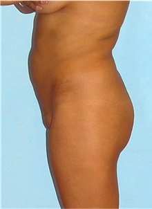 Buttock Lift with Augmentation Before Photo by Siamak Agha, MD PhD FACS; Newport Beach, CA - Case 43813