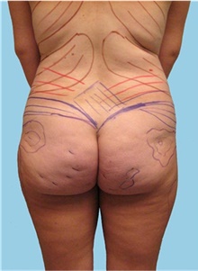Buttock Lift with Augmentation Before Photo by Siamak Agha, MD PhD FACS; Newport Beach, CA - Case 43814