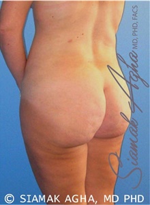 Buttock Lift with Augmentation After Photo by Siamak Agha, MD PhD FACS; Newport Beach, CA - Case 43814
