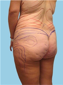 Buttock Lift with Augmentation Before Photo by Siamak Agha, MD PhD FACS; Newport Beach, CA - Case 43814