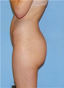 Buttock Lift with Augmentation Before Photo by Siamak Agha, MD PhD FACS; Newport Beach, CA - Case 43815