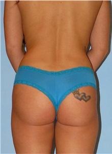 Buttock Lift with Augmentation Before Photo by Siamak Agha, MD PhD FACS; Newport Beach, CA - Case 43816