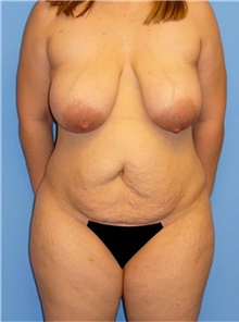 Mommy Makeover Before Photo by Siamak Agha, MD PhD FACS; Newport Beach, CA - Case 43822