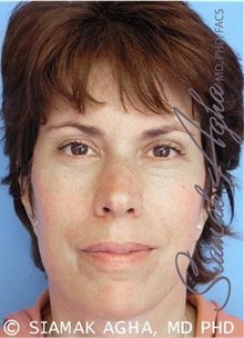 Facelift After Photo by Siamak Agha, MD PhD FACS; Newport Beach, CA - Case 43834
