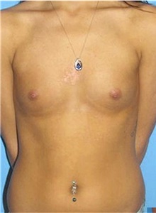 Breast Augmentation Before Photo by Siamak Agha, MD PhD FACS; Newport Beach, CA - Case 43853