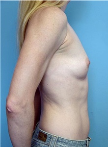 Breast Augmentation Before Photo by Siamak Agha, MD PhD FACS; Newport Beach, CA - Case 43855