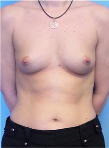 Breast Augmentation Before Photo by Siamak Agha, MD PhD FACS; Newport Beach, CA - Case 43856