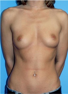 Breast Augmentation Before Photo by Siamak Agha, MD PhD FACS; Newport Beach, CA - Case 43857