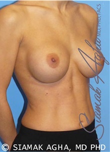Breast Augmentation After Photo by Siamak Agha, MD PhD FACS; Newport Beach, CA - Case 43858