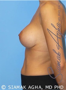 Breast Augmentation After Photo by Siamak Agha, MD PhD FACS; Newport Beach, CA - Case 43858
