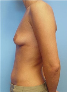 Breast Augmentation Before Photo by Siamak Agha, MD PhD FACS; Newport Beach, CA - Case 43858