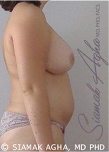 Breast Augmentation After Photo by Siamak Agha, MD PhD FACS; Newport Beach, CA - Case 43859