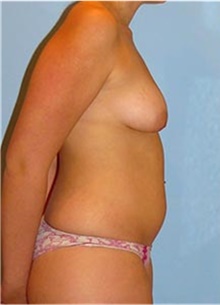 Breast Augmentation Before Photo by Siamak Agha, MD PhD FACS; Newport Beach, CA - Case 43859