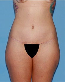 Body Lift After Photo by Siamak Agha, MD; Newport Beach, CA - Case 43874