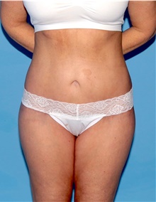 Body Lift After Photo by Siamak Agha, MD; Newport Beach, CA - Case 43880