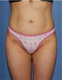 Buttock Lift with Augmentation After Photo by Siamak Agha, MD PhD FACS; Newport Beach, CA - Case 43910