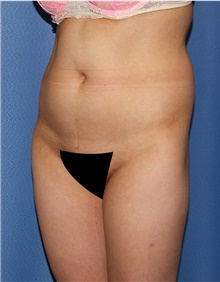 Buttock Lift with Augmentation Before Photo by Siamak Agha, MD PhD FACS; Newport Beach, CA - Case 43910