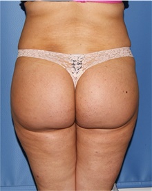 Buttock Lift with Augmentation After Photo by Siamak Agha, MD PhD FACS; Newport Beach, CA - Case 43911