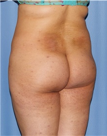 Buttock Lift with Augmentation Before Photo by Siamak Agha, MD PhD FACS; Newport Beach, CA - Case 43911