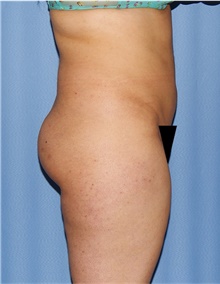 Buttock Lift with Augmentation Before Photo by Siamak Agha, MD PhD FACS; Newport Beach, CA - Case 43911