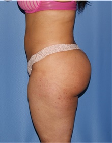 Buttock Lift with Augmentation After Photo by Siamak Agha, MD PhD FACS; Newport Beach, CA - Case 43911