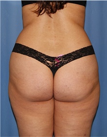 Buttock Lift with Augmentation Before Photo by Siamak Agha, MD PhD FACS; Newport Beach, CA - Case 43912