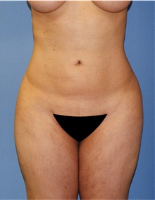 Buttock Lift with Augmentation After Photo by Siamak Agha, MD PhD FACS; Newport Beach, CA - Case 43912