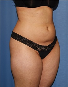 Buttock Lift with Augmentation Before Photo by Siamak Agha, MD PhD FACS; Newport Beach, CA - Case 43912