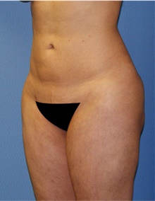 Buttock Lift with Augmentation After Photo by Siamak Agha, MD PhD FACS; Newport Beach, CA - Case 43912