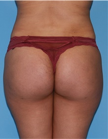 Buttock Lift with Augmentation After Photo by Siamak Agha, MD PhD FACS; Newport Beach, CA - Case 43913