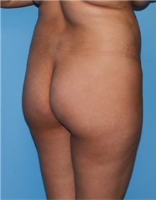 Buttock Lift with Augmentation Before Photo by Siamak Agha, MD PhD FACS; Newport Beach, CA - Case 43913