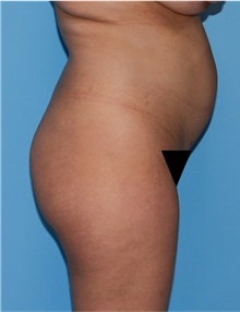 Buttock Lift with Augmentation Before Photo by Siamak Agha, MD PhD FACS; Newport Beach, CA - Case 43913