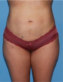Buttock Lift with Augmentation After Photo by Siamak Agha, MD PhD FACS; Newport Beach, CA - Case 43913