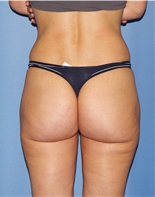 Buttock Lift with Augmentation After Photo by Siamak Agha, MD; Newport Beach, CA - Case 43914