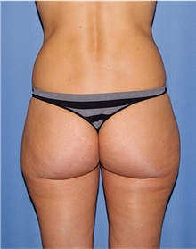 Buttock Lift with Augmentation Before Photo by Siamak Agha, MD; Newport Beach, CA - Case 43914