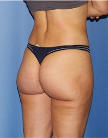 Buttock Lift with Augmentation After Photo by Siamak Agha, MD PhD FACS; Newport Beach, CA - Case 43914