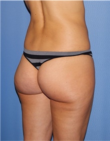 Buttock Lift with Augmentation Before Photo by Siamak Agha, MD PhD FACS; Newport Beach, CA - Case 43914