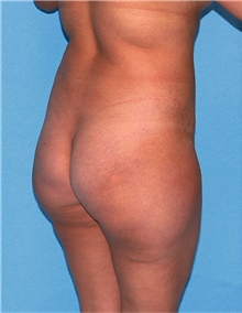 Buttock Lift with Augmentation Before Photo by Siamak Agha, MD PhD FACS; Newport Beach, CA - Case 43916