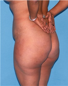 Buttock Lift with Augmentation Before Photo by Siamak Agha, MD PhD FACS; Newport Beach, CA - Case 43916