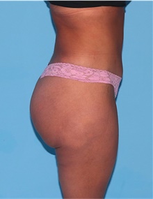 Buttock Lift with Augmentation After Photo by Siamak Agha, MD PhD FACS; Newport Beach, CA - Case 43916