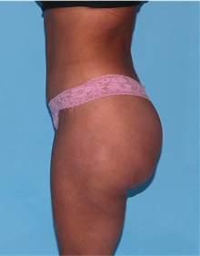 Buttock Lift with Augmentation After Photo by Siamak Agha, MD PhD FACS; Newport Beach, CA - Case 43916