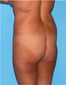 Buttock Lift with Augmentation Before Photo by Siamak Agha, MD PhD FACS; Newport Beach, CA - Case 43917