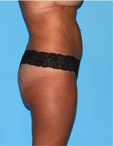 Buttock Lift with Augmentation After Photo by Siamak Agha, MD PhD FACS; Newport Beach, CA - Case 43917