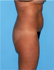 Buttock Lift with Augmentation Before Photo by Siamak Agha, MD PhD FACS; Newport Beach, CA - Case 43917