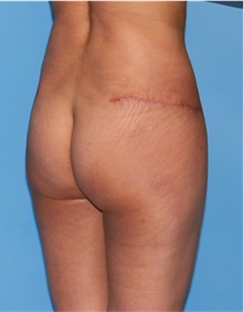 Buttock Lift with Augmentation After Photo by Siamak Agha, MD PhD FACS; Newport Beach, CA - Case 43918