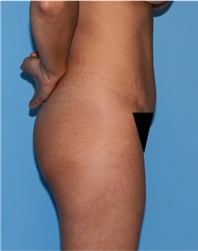 Buttock Lift with Augmentation Before Photo by Siamak Agha, MD PhD FACS; Newport Beach, CA - Case 43918