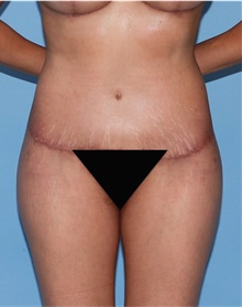 Buttock Lift with Augmentation After Photo by Siamak Agha, MD PhD FACS; Newport Beach, CA - Case 43918