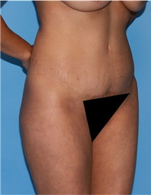Buttock Lift with Augmentation Before Photo by Siamak Agha, MD PhD FACS; Newport Beach, CA - Case 43918